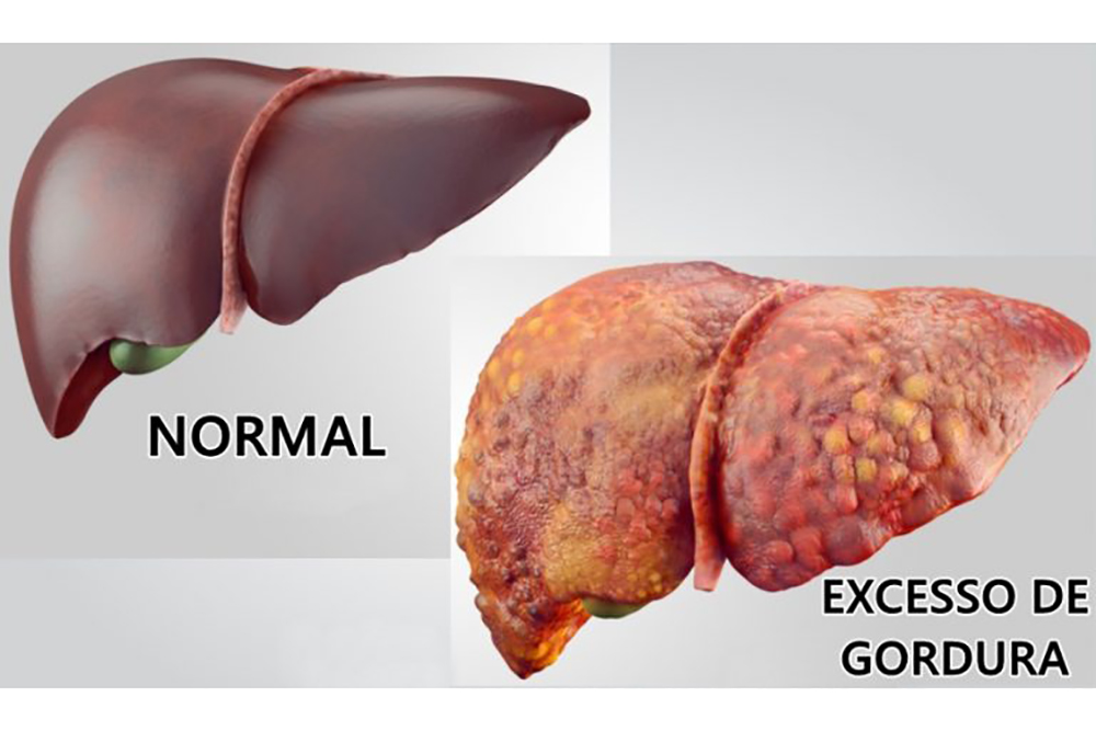 Conheça as causas sintomas e como tratar a esteatose hepática gordura