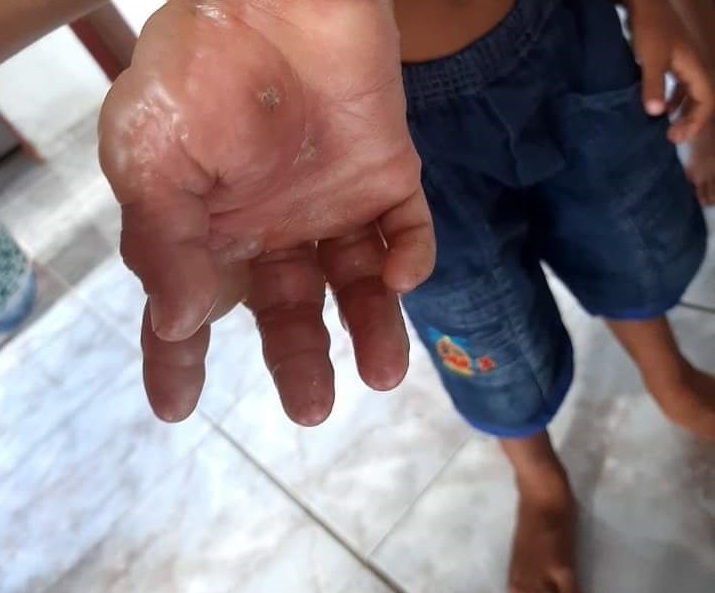 Mãe é denunciada por maus tratos e filho tem grave queimadura na mão Mãe é denunciada por maus tratos e filho tem grave queimadura na mão