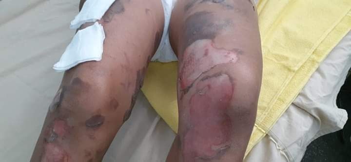 Marido que colocou fogo na companheira é preso em Manacapuru Marido que colocou fogo na companheira é preso em Manacapuru