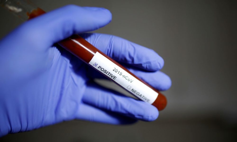S&atilde;o Paulo confirma primeiro caso de reinfec&ccedil;&atilde;o por coronav&iacute;rus