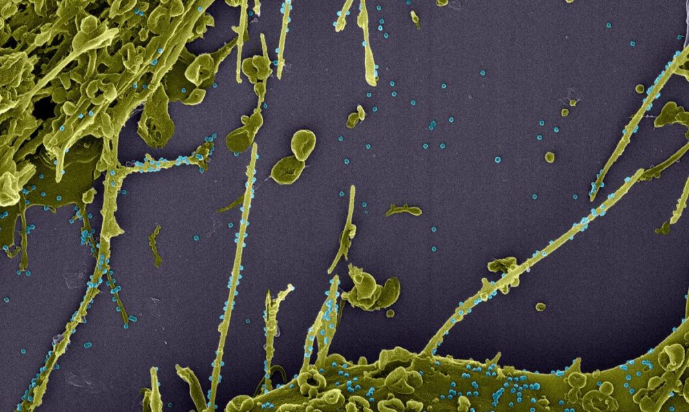 Estudo constata infecção simultânea por duas linhagens da Covid Estudo constata infecção simultânea por duas linhagens da Covid