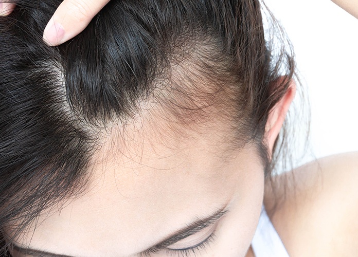 Covid-19: Até 50% dos pacientes podem desenvolver queda de cabelo Covid-19: Até 50% dos pacientes podem desenvolver queda de cabelo