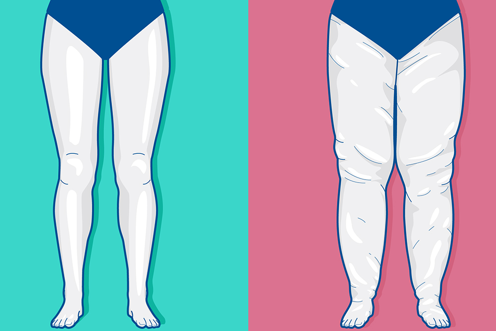 Conheça a doença que provoca deformação corporal e é confundida com obesidade Conheça a doença que provoca deformação corporal e é confundida com obesidade