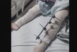 Menina de seis anos é vítima de erro médico após pinos serrem colocados em perna errada