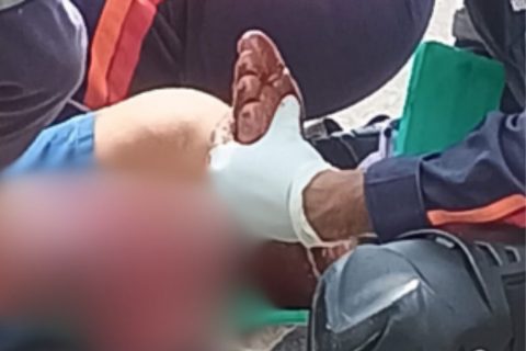 Motociclista tem fratura exposta na perna após acidente na avenida das Torres