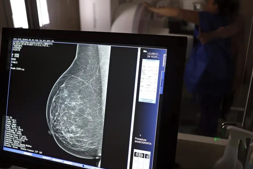 Cerca de 77 mil mulheres aguardam mamografia pelo SUS