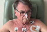 Bolsonaro tem drenos abdominais retirados e apresenta boa recuperação após cirurgia