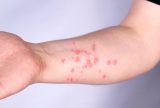 Mpox ou sarampo? Saiba como diferenciar sintomas e quando procurar ajuda médica