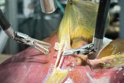 Inteligência artificial conduz 1ª cirurgia sem presença humana.
