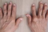 Falta de centros de infusão no SUS compromete tratamento de artrite reumatoide, alerta entidade