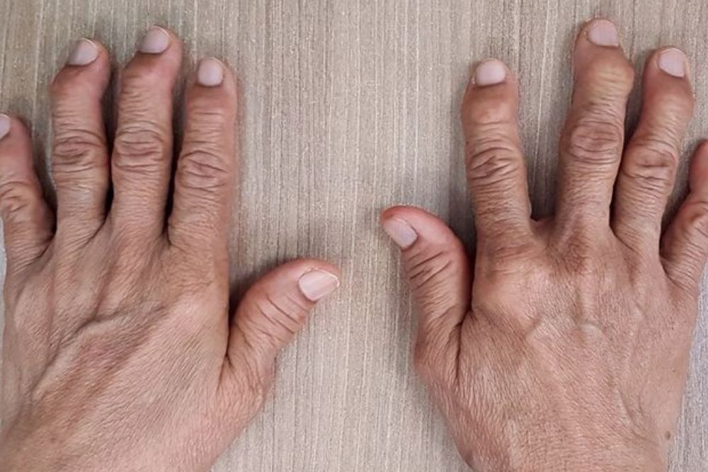 Falta de centros de infusão no SUS compromete tratamento de artrite reumatoide, alerta entidade Falta de centros de infusão no SUS compromete tratamento de artrite reumatoide, alerta entidade