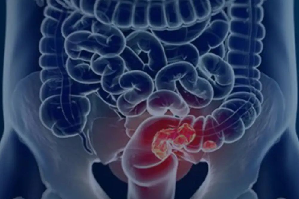 Câncer colorretal ainda é identificado tardiamente na maior parte dos pacientes, revela estudo