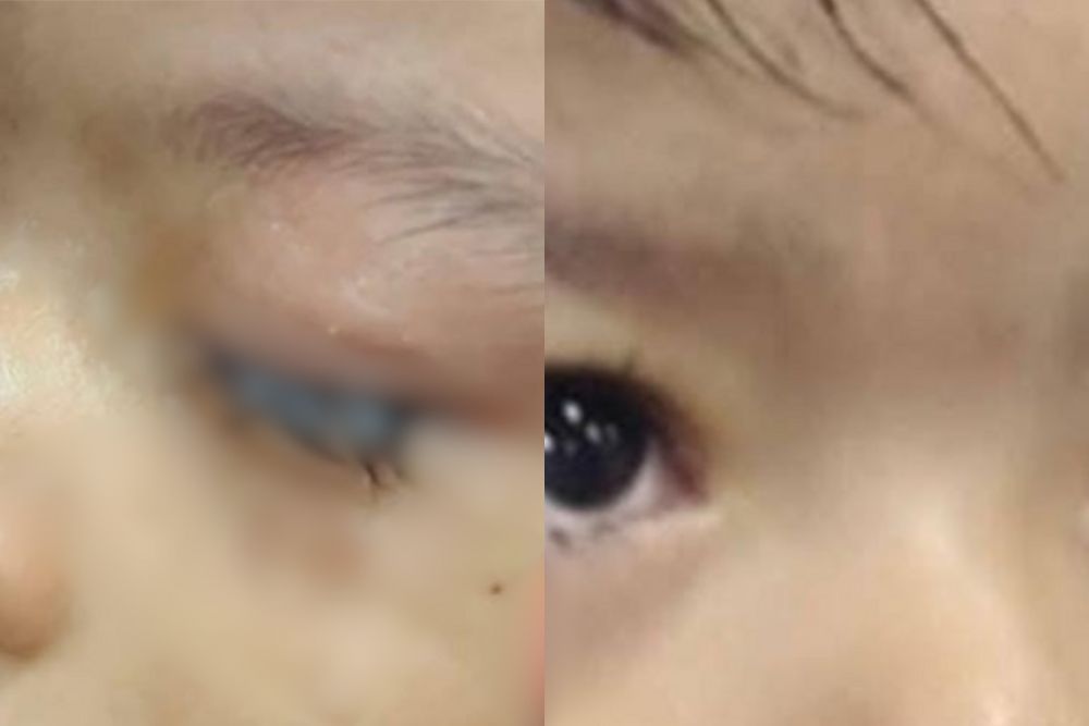 Criança de 2 anos tem olhos colados por cola industrial após acidente doméstico em Parintins