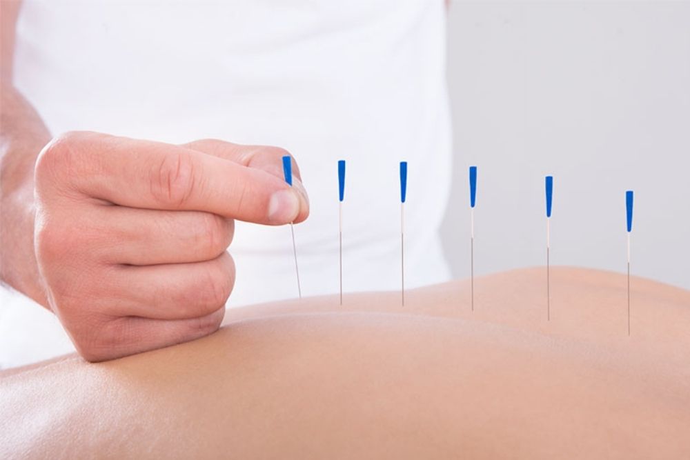 Brasil regulamenta exercício profissional da acupuntura
