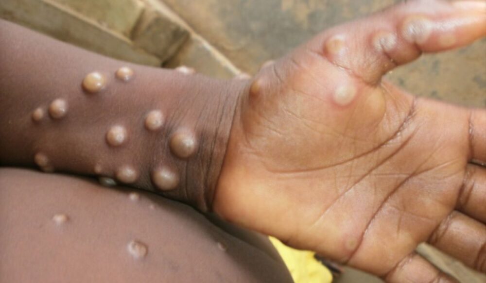Brasil registra 88 casos de Mpox em 2026 e autoridades reforçam medidas de prevenção