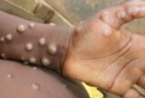 Brasil registra 88 casos de Mpox em 2026 e autoridades reforçam medidas de prevenção