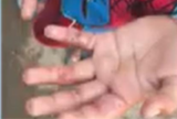 Menino de 5 anos é resgatado após sofrer queimaduras nas mãos em Manaus