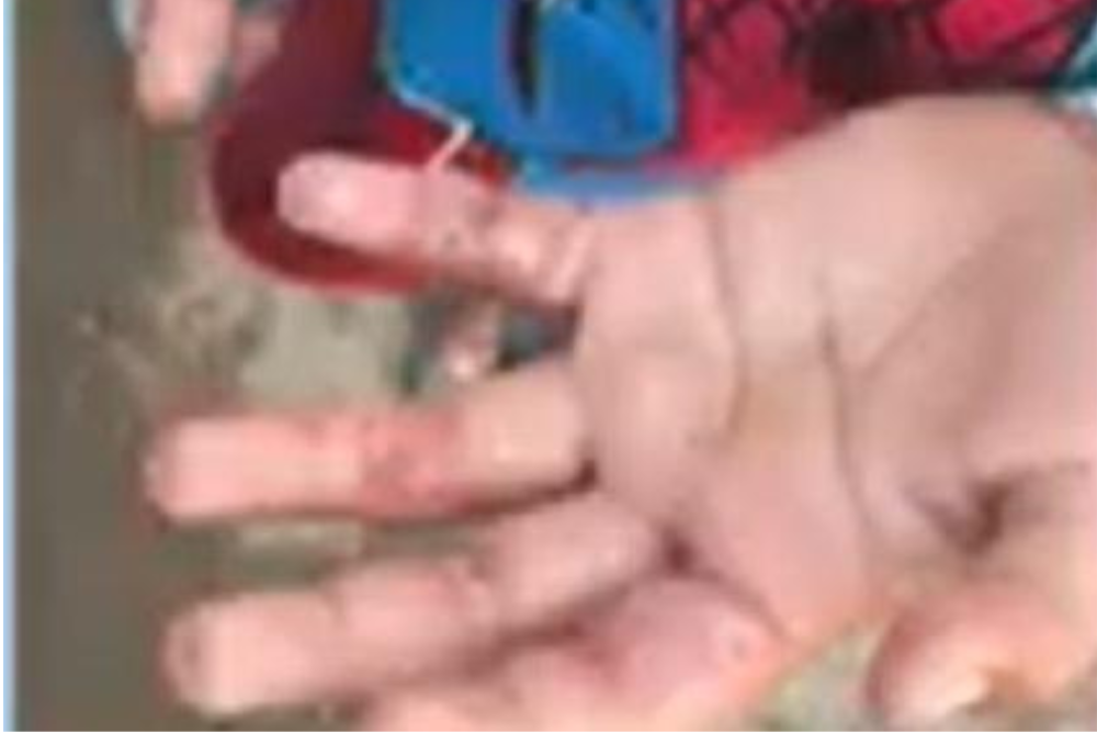 Menino de 5 anos é resgatado após sofrer queimaduras nas mãos em Manaus